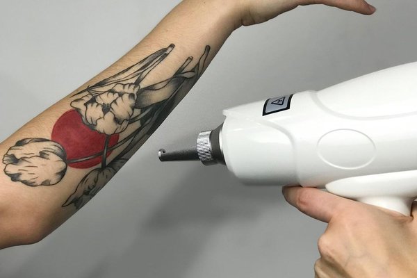 Advantages of laser removal