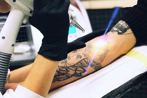 Advantages of laser removal