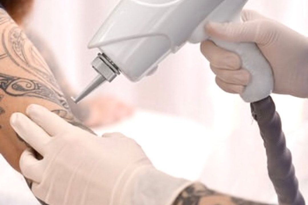 Laser tattoo removal in Dubno