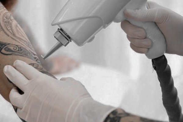Удаление тату в Ирпене